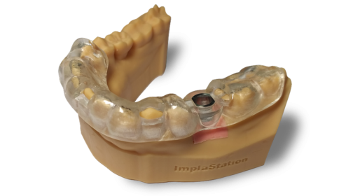 photo_teeth-supported-guide_-494x280.png